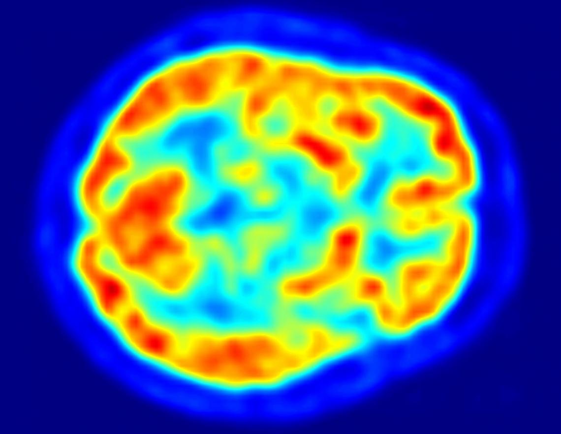 UA researchers studied brain images of 124 cognitively normal, non-diabetic adults with a family history of Alzheimer's disease. UA researchers studied brain images of 124 cognitively normal, non-diabetic adults with a family history of Alzheimer's disease.